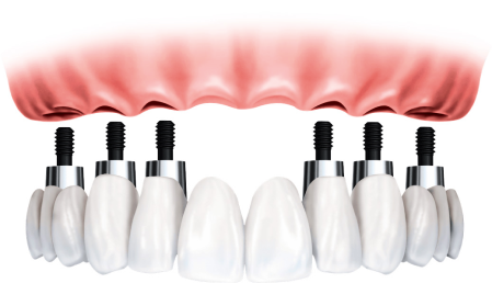 All-on-Six Implants
