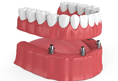 Complete/Full Denture Implant