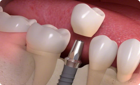 Single Theet Implant