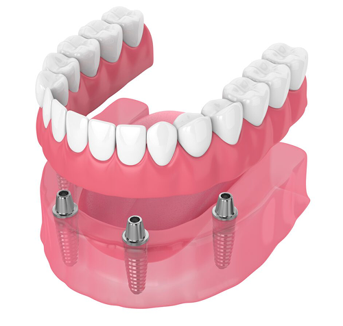 Benefits of All on 4 Dental Implants vs. Regular Implant