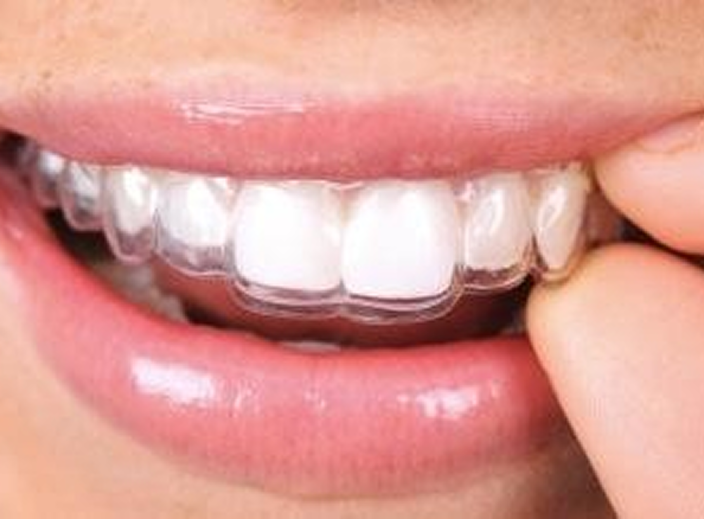 Clear Aligners