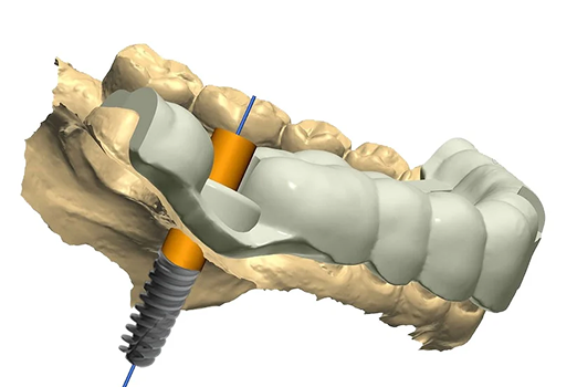 Dental Implant Image 1
