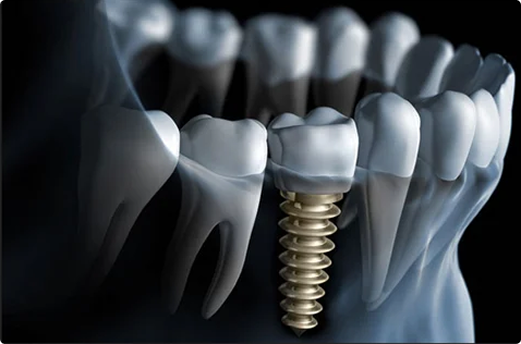 Dental Implant Image 2