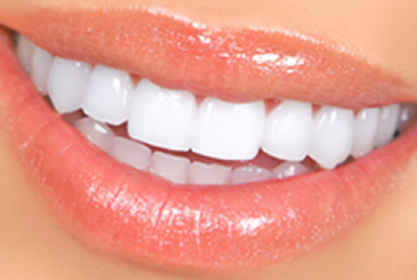 Dental Veneers