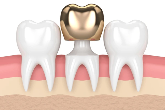 Metals crowns