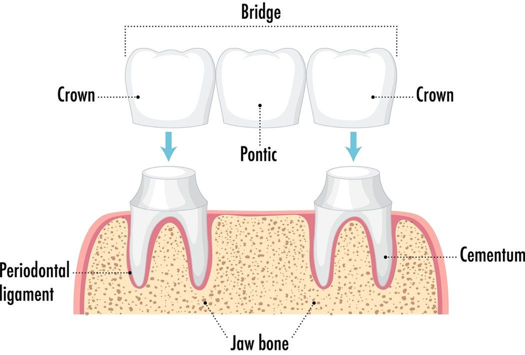 All-ceramic or all-porcelain Crowns