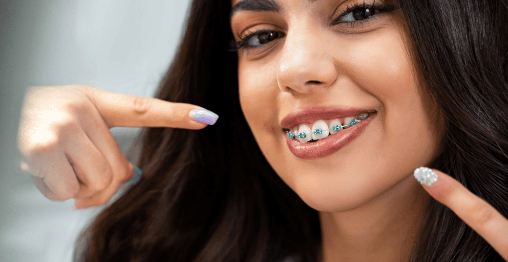 Dental Braces Treatment in Ahmedabad