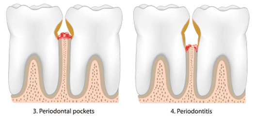 Who can have Gum Disease?