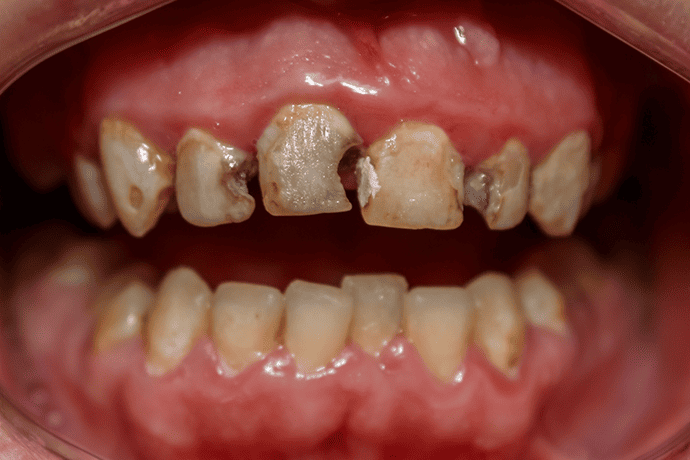 Forms of Periodontitis