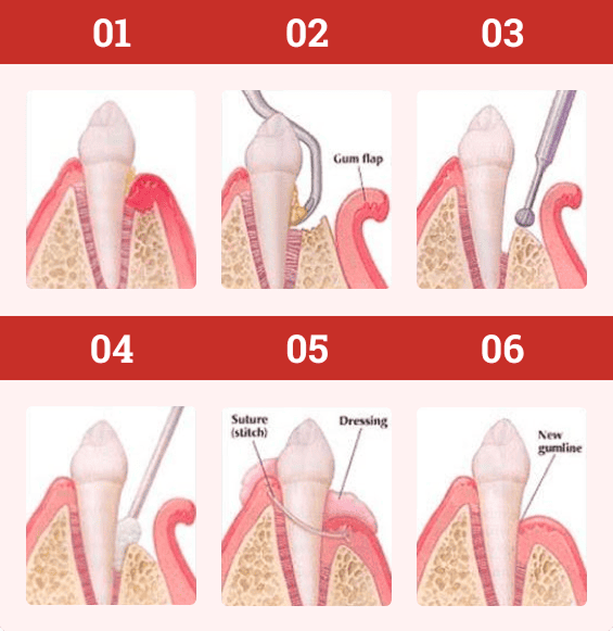 How Laser gum treatment is performed?