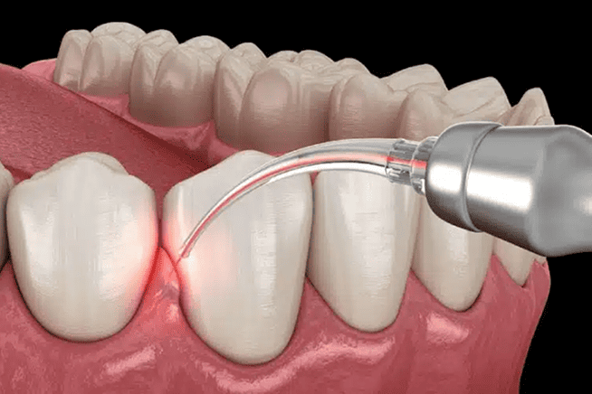 Advantages of Laser Gum Treatment