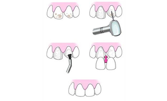 Veneers Fix Problems