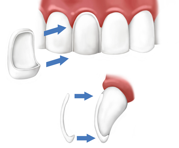 Veneers Fix Problems