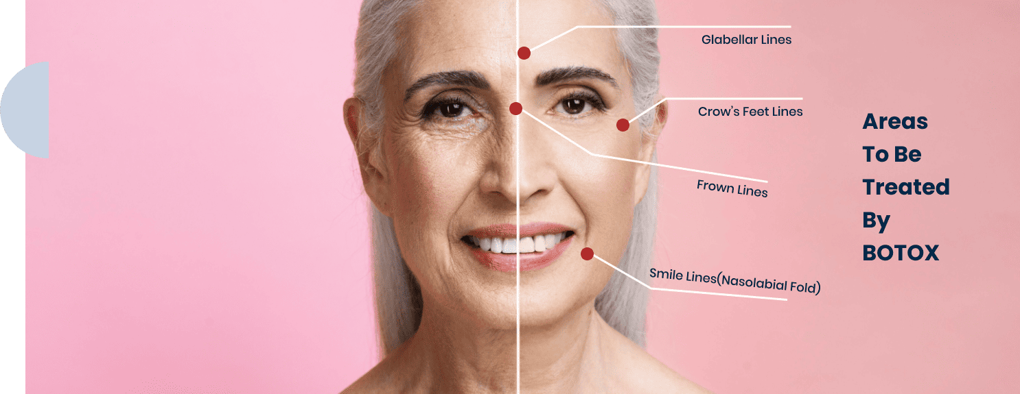 Areas To Be Treated By BOTOX