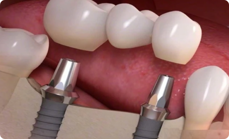 Single Theet Implant