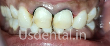 A Permanent Solution Which Lasts Longer Compared to Older Composite Filling - Case of the Month